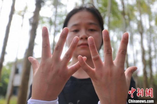 吳素英展示被蜜蜂蜇過的雙手。湯曉逵 攝