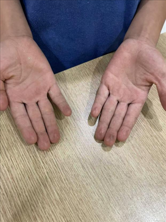 9歲小學(xué)生長(zhǎng)期拍煙卡，手部粗糙長(zhǎng)繭。受訪者供圖